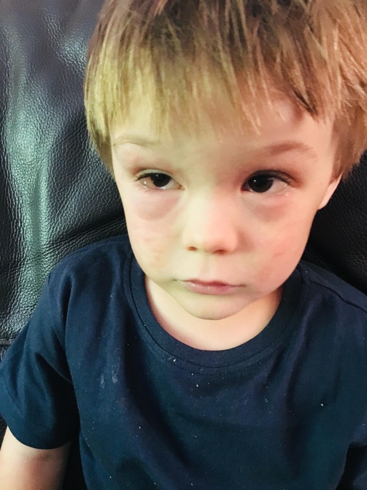 A picture of a mother holding her baby who has severe eczema on his face and arms